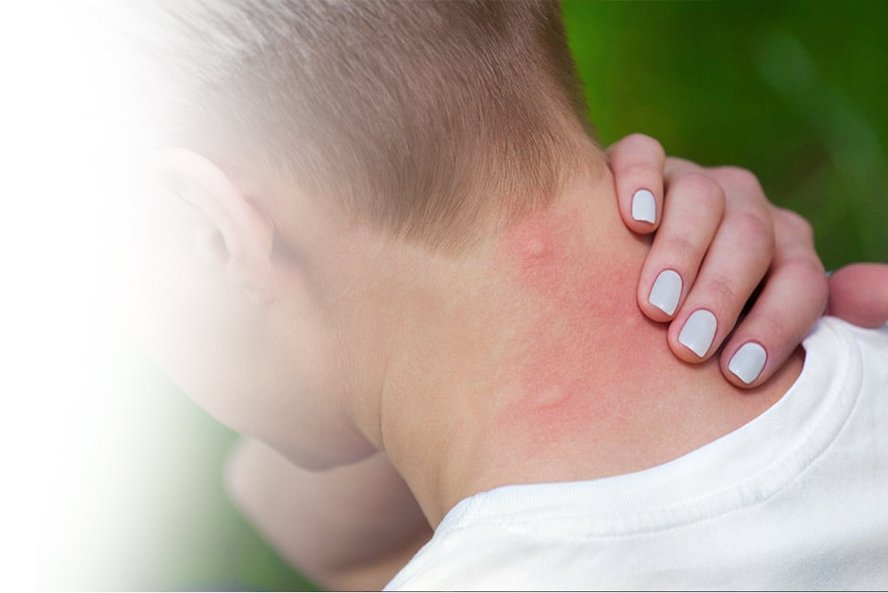 Why Do Mosquito Bites Itch?
